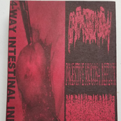 4-WAY INTESTINAL INFECTION