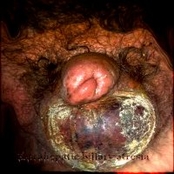 Extrahepatic Billary Atresia