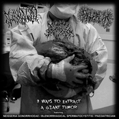 3 Ways to Extract a Giant Tumor