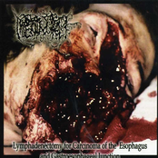 Lymphadenectomy For Carcinoma Of The Esophagus And Gastroesophageal Junction