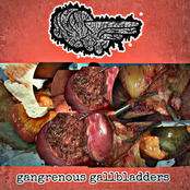 Gangrenous Gallbladders