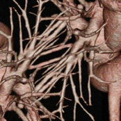 Weak Incision - Single