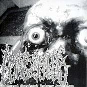 Ruptured Cerebral Artery Aneurism