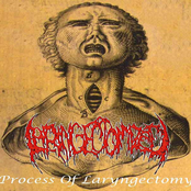 Process Of Laryngectomy
