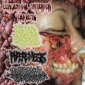 4 Way Hemangiopericytoma Split