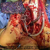 Retroperitoneal Splenic Laparoscopic Pancreatectomy