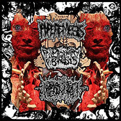 Hyperemesis / Pulmonary Fibrosis / Hipermenorrea