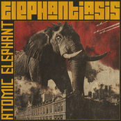 Elephantiasis