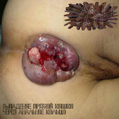 Выпадение прямой кишки через анальное кольцо