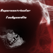 Supraventricular Tachycardia