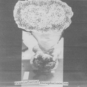 Craniofacial Encephaloceles