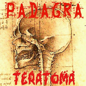 Teratoma
