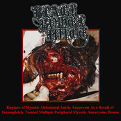 Rupture of Mycotic Abdominal Aortic Aneurysm as a Result of Incompletely Treated Multiple Peripheral Mycotic Aneurysms Demos