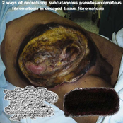 2 Ways of Necrotizing Subcutaneous Pseudosarcomatous Fibromatosis in Decayed Tissue Fibromatosis