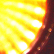 Intolerable Photosensitivity