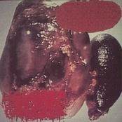 Liquified Organ Catheter / Pseudocyst