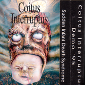 Sudden Infant Death Syndrome