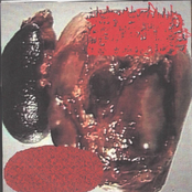 Pseudocyst / Liquified Organ Catheter