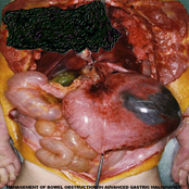 Management of Bowel Obstruction in Advanced Gastric Malignancy