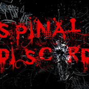 spinal discord