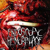 Endoscopyc Hemorrhage