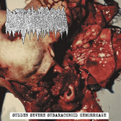 Sudden Severe Subarachnoid Hemorrhage