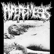 Hyperemesis / Deep Fried Embryo