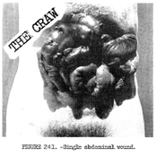 Figure 241. Single abdominal wound