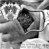 Detailed Coverage On The Different Types & Procedures Of Orthopedic Hand Surgery