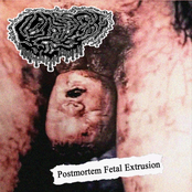 Postmortem fetal extrusion EP