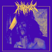 Subdural Hematoma (Demo)