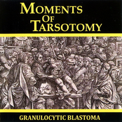 moments of tarsotomy