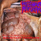 malignant neoplasm