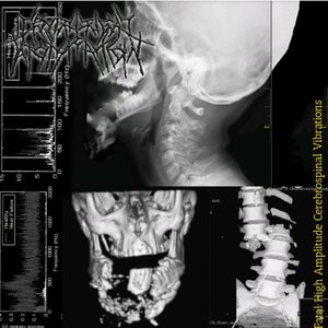 Fatal High Amplitude Cerebrospinal Vibrations