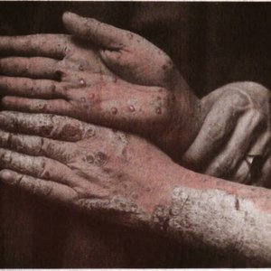 Pustular Psoriasis