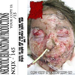 Necrotic Gangrene Due to Extensive Krokodil Abuse