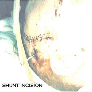 Shunt Incision