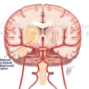 Cerebral Attack