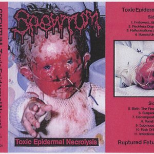Toxic Epedermal Necrolysis
