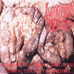 Malignant Cancerous Tumor in the Epitelial Tissue of the Intestine cover