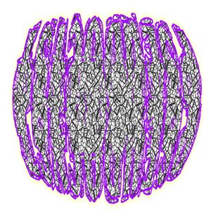 Avatar for Pseudocyst