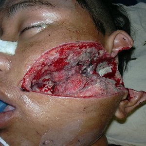 Split with Hyperemesis