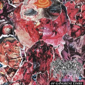 Of Gangrene Limbs
