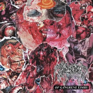 Of Gangrene Limbs - Single