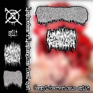 Split with Lymphangioma Foeal Cyst