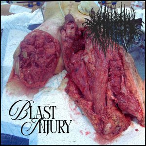 Blast Injury