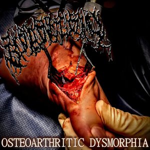 Osteoarthritic Dysmorphia