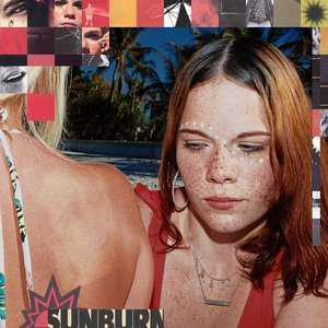 Sunburn