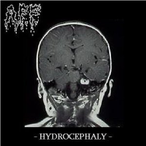 Hydrocephaly