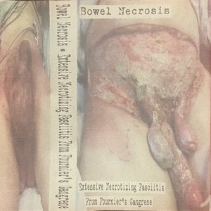 Extensive Necrotizing Fasciitis From Fournier's Gangrene